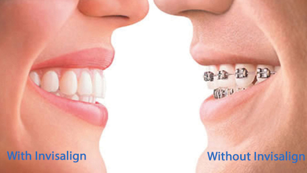 invisalign in Des Peres