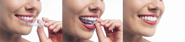 invisalign 63131